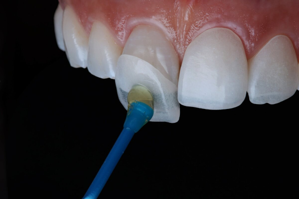 Cómo pueden ayudarme las carillas dentales
