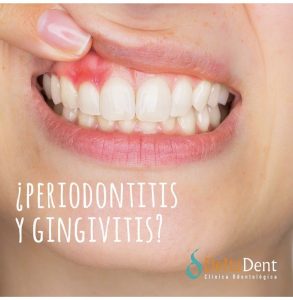 periodontitis